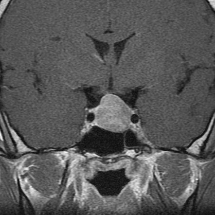 Brain Tumors | Playlist | Radiopaedia.org