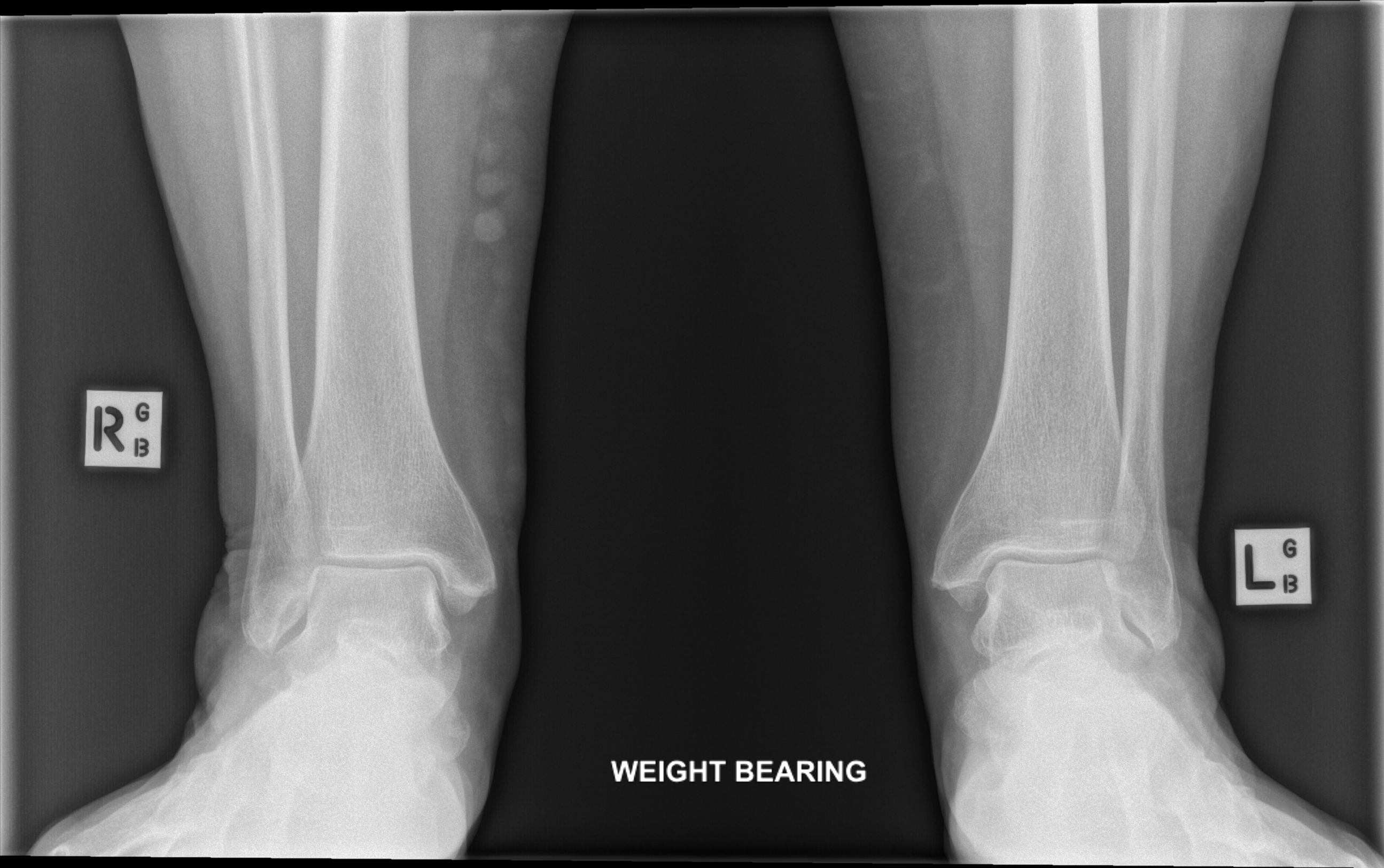 Ankle Syndesmotic Injury (weight-bearing X-ray) | Image | Radiopaedia.org