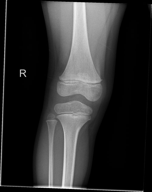 Normal knee series - pediatric | Radiology Case | Radiopaedia.org