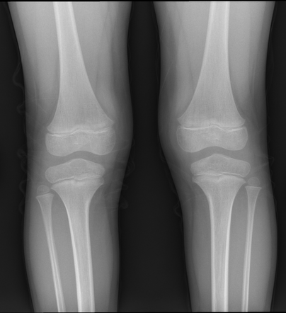 Normal weight-bearing knee radiograph - pediatric | Radiology Case ...