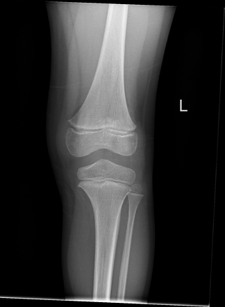 Normal knee series - pediatric | Radiology Case | Radiopaedia.org