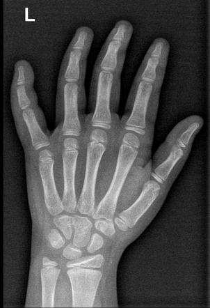 Phalanx fracture - hand | Radiology Case | Radiopaedia.org