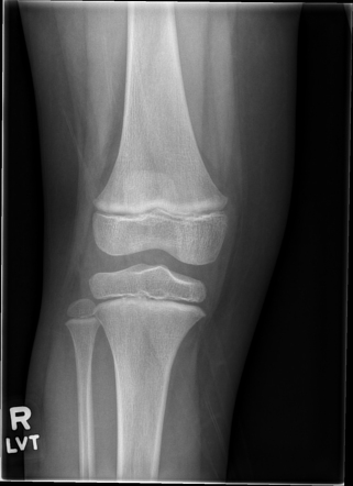 Normal knee radiographs - pediatric | Radiology Case | Radiopaedia.org