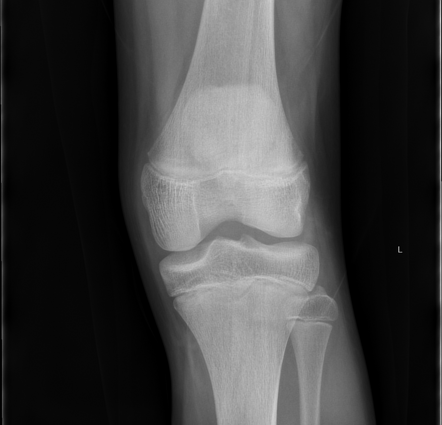 Normal knee radiographs - paediatric | Radiology Case | Radiopaedia.org