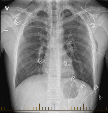 Pneumomediastinum | Radiology Case | Radiopaedia.org