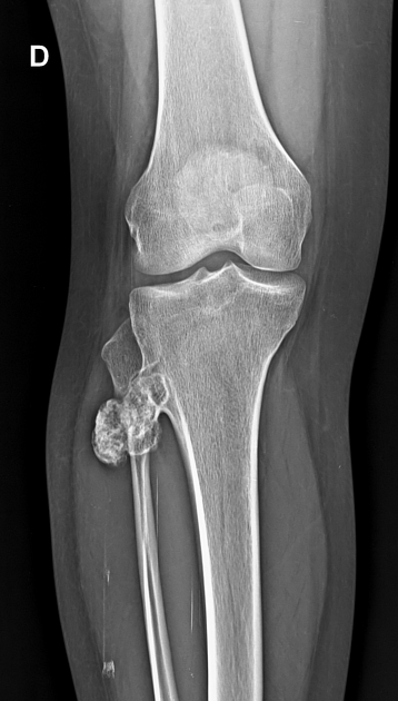 File:Enchondrom Tibia 83jm - Roe ap und seitlich - 001.jpg - Wikimedia  Commons