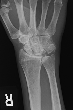 Volar intercalated segment instability (VISI) | Radiology Case ...