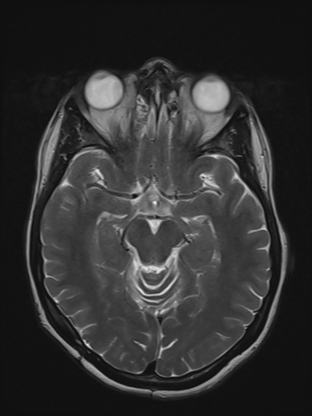 Von Hippel-Lindau Disease | Image | Radiopaedia.org