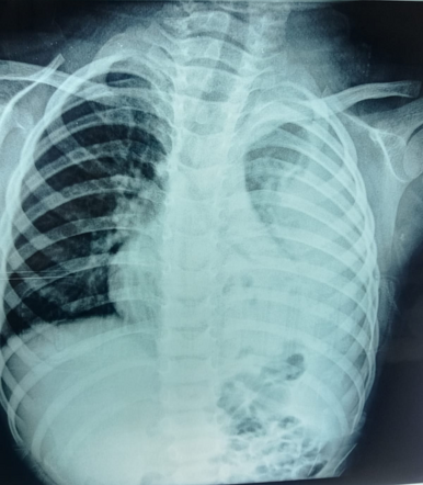 Pneumonia | Radiology Case | Radiopaedia.org