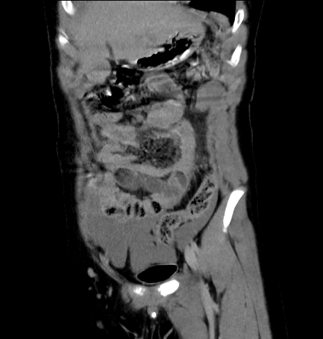 File:Renal, splenic and hepatic lacerations (Radiopaedia 12465-12707 ...