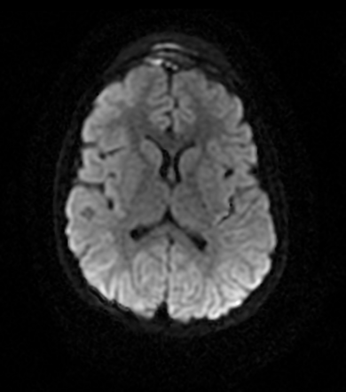 Pott puffy tumour | Radiology Case | Radiopaedia.org