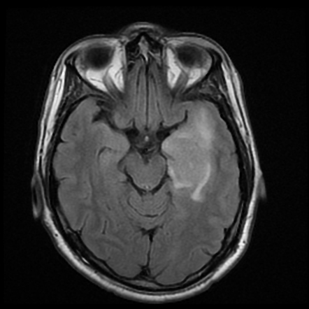 CNS lymphoma | Radiology Case | Radiopaedia.org