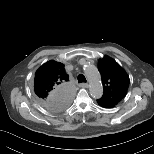 Large cell neuroendocrine carcinoma of the lung | Image | Radiopaedia.org