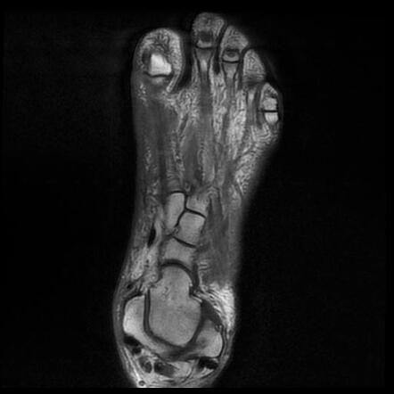 First metatarsal and great toe osteomyelitis and septic arthritis of ...