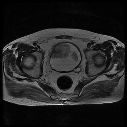 Multifocal urothelial cell carcinoma of the bladder | Radiology Case ...