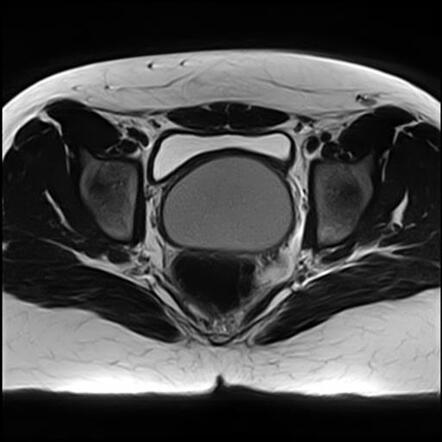 Hematocolpos in uterus didelphys | Image | Radiopaedia.org