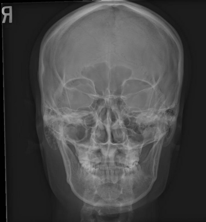 Normal facial bones series | Radiology Case | Radiopaedia.org