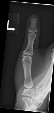 Normal thumb series | Radiology Case | Radiopaedia.org