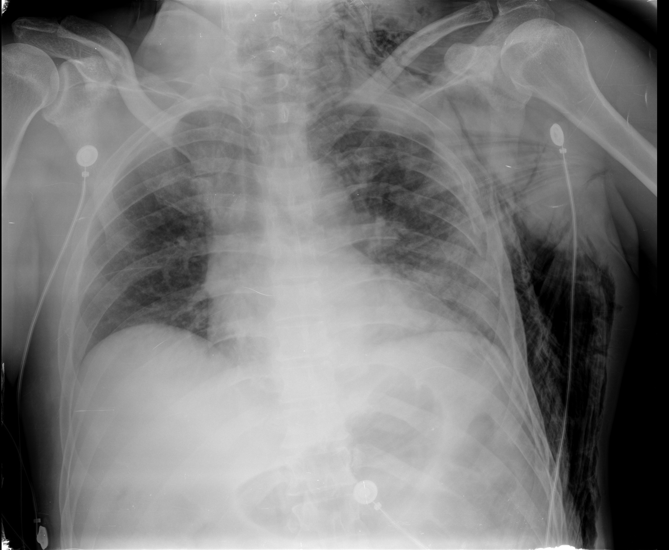 Blunt Chest Trauma | Image | Radiopaedia.org