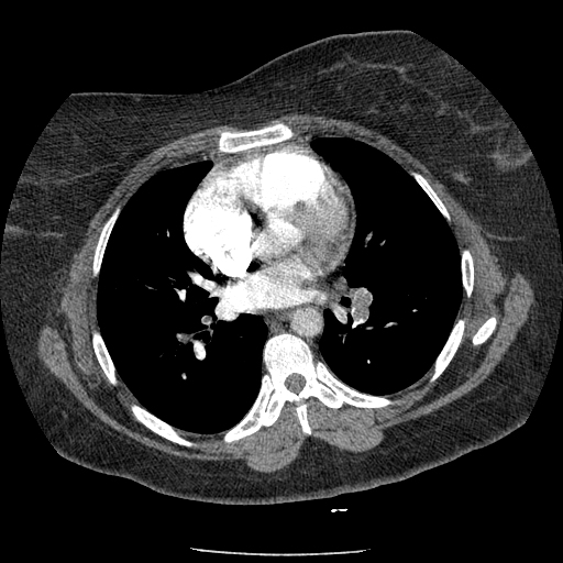 Chronic pulmonary thromboembolism | Image | Radiopaedia.org