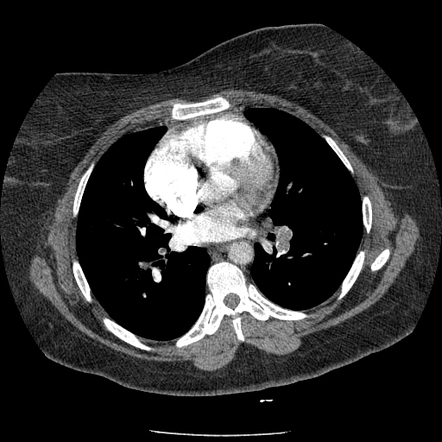 Chronic pulmonary thromboembolism | Radiology Case | Radiopaedia.org