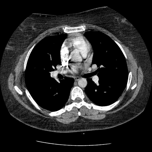 Chronic pulmonary thromboembolism | Image | Radiopaedia.org