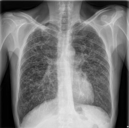 Pulmonary Langerhan’s cell histiocytosis | Radiology Case | Radiopaedia.org