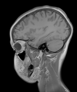 Wilson disease | Image | Radiopaedia.org