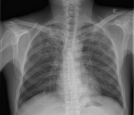 Pneumocystis jirovecii pneumonia | Radiology Case | Radiopaedia.org