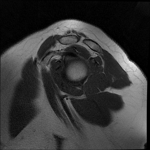 Humeral greater tuberosity avulsion fracture | Image | Radiopaedia.org