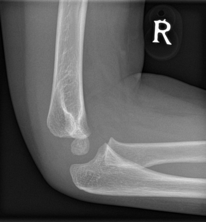 Normal x-ray elbow - 4 years | Radiology Case | Radiopaedia.org