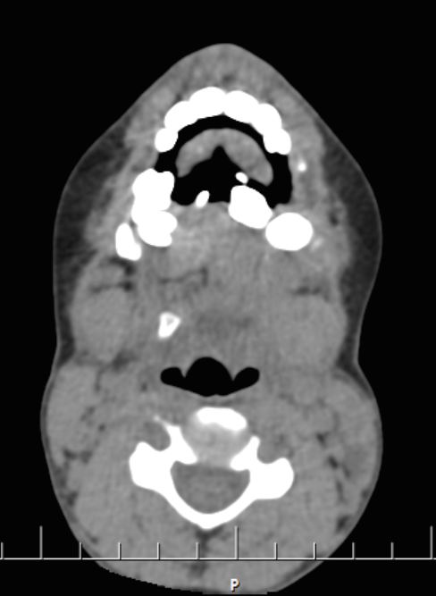 Gorham's disease - mandible | Image | Radiopaedia.org