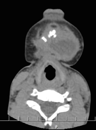 Gorham's disease - mandible | Radiology Case | Radiopaedia.org