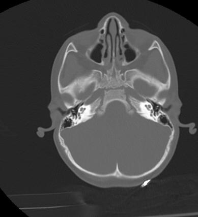 Craniocervical dissociation | Image | Radiopaedia.org