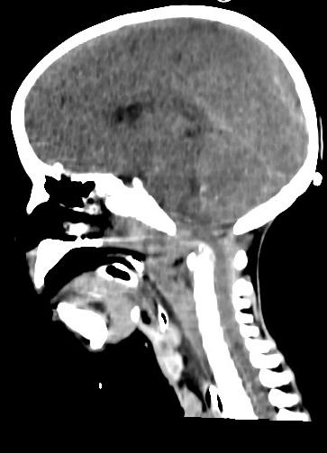 Craniocervical dissociation | Image | Radiopaedia.org