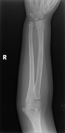 Torus fracture of distal radius | Radiology Case | Radiopaedia.org