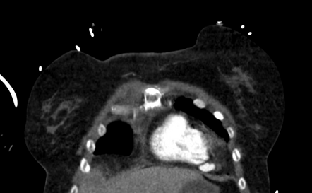 Right ventricle pseudoaneurysm | Radiology Case | Radiopaedia.org