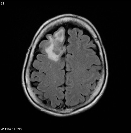 Gangliocytoma | Image | Radiopaedia.org