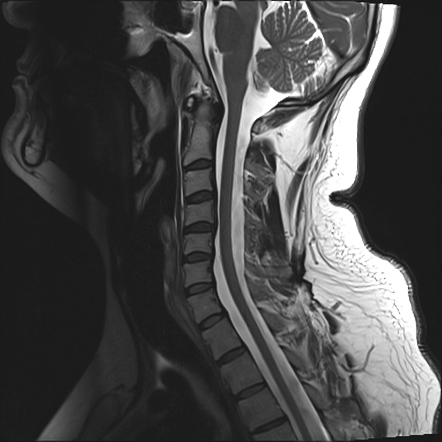 Subacute combined degeneration of the cord | Radiology Case ...