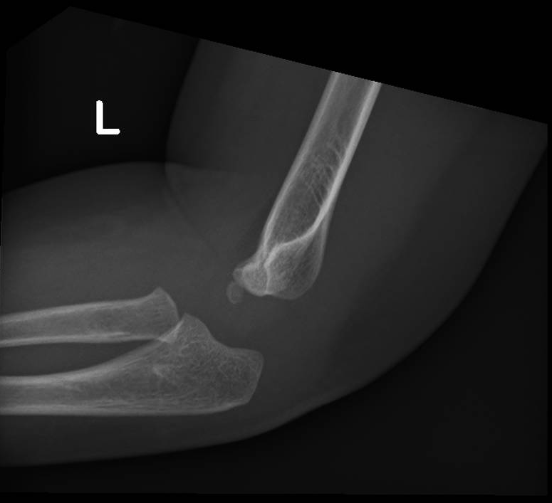 Normal Pediatric Elbow Series (2 Years) 