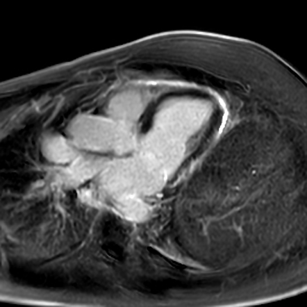 Myopericarditis | Radiology Case | Radiopaedia.org