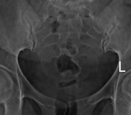 Bilateral tubal block and hydrosalpinx | Image | Radiopaedia.org