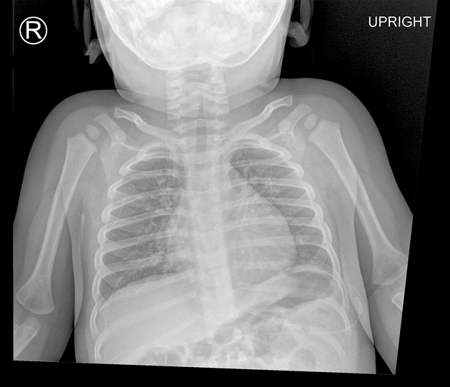 Steeple sign (trachea), Radiology Reference Article