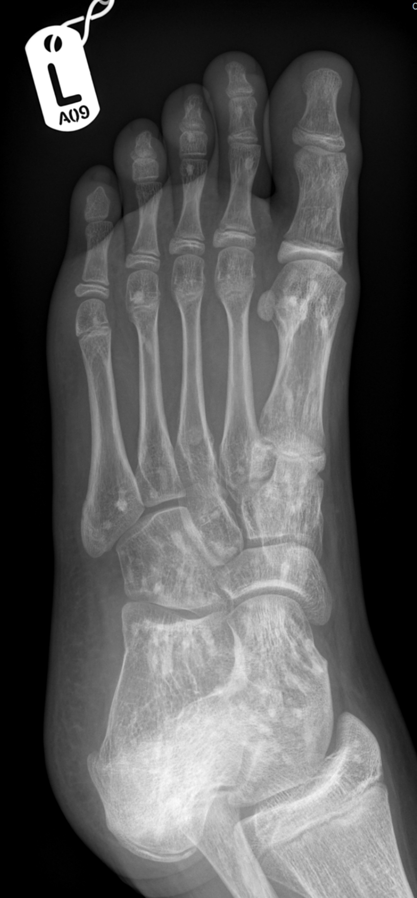 Osteopoikilosis | Image | Radiopaedia.org