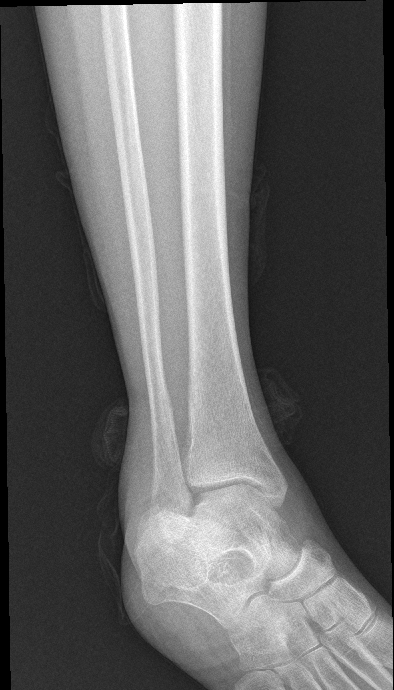 Lateral malleolus avulsion fracture | Image | Radiopaedia.org