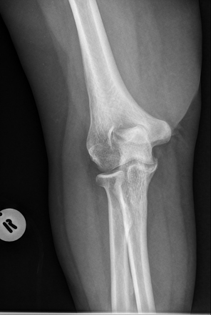 Coronoid process fracture | Radiology Case | Radiopaedia.org