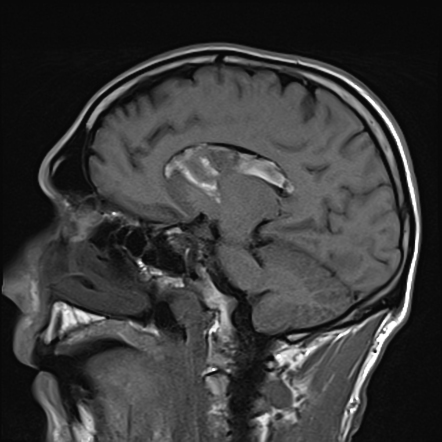 Hypertensive intracranial haemorrhage | Radiology Case | Radiopaedia.org