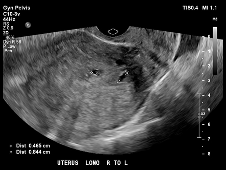 Adenomyosis | Radiology Case | Radiopaedia.org