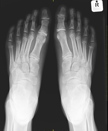 Sever disease (calcaneal apophysitis) | Radiology Case | Radiopaedia.org