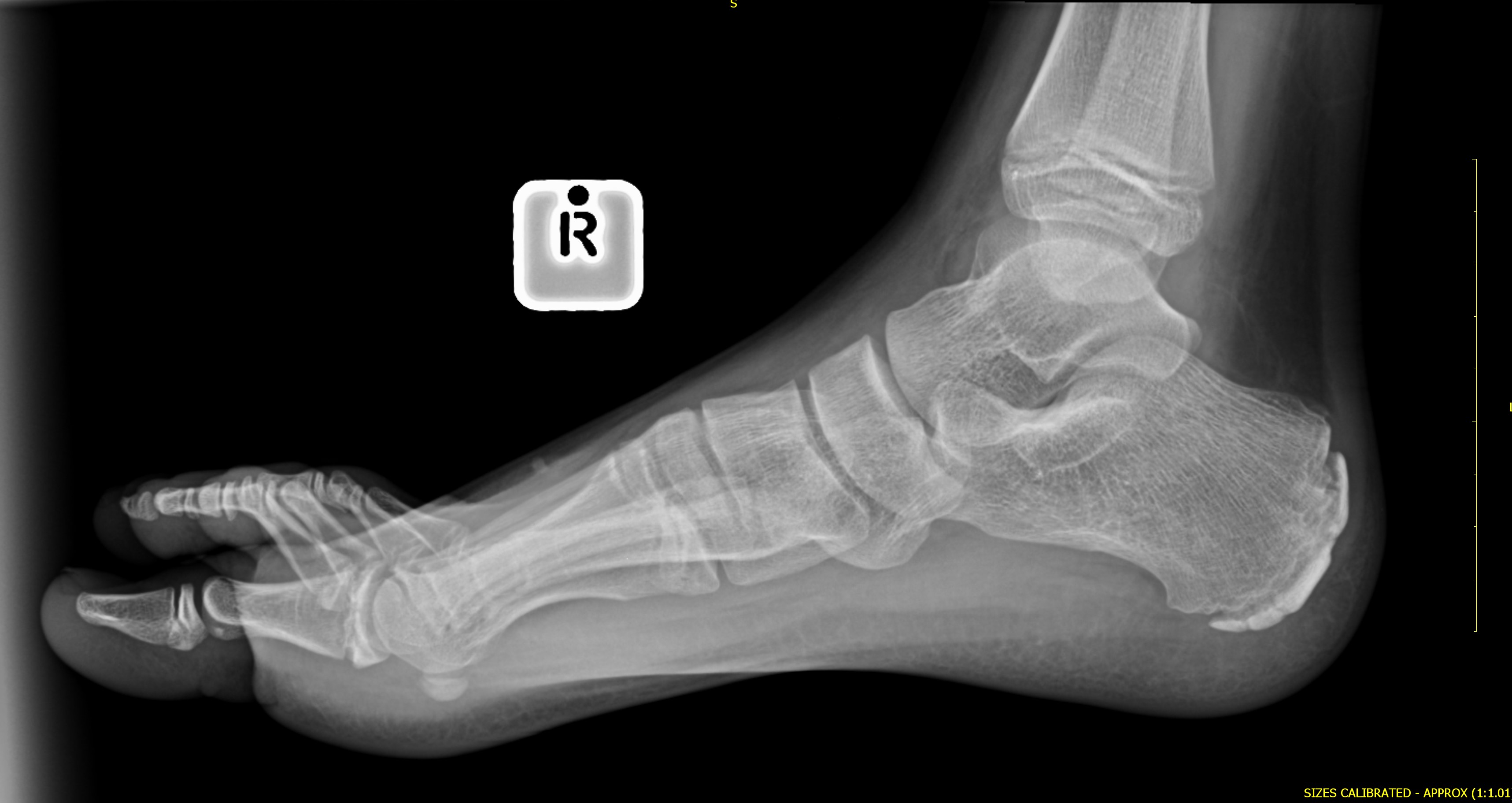 Sever Disease (calcaneal Apophysitis) 